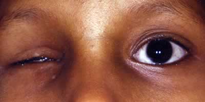 Anophthalmia - Eyes Alive